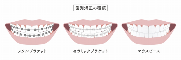 マウスピース矯正(インビザライン)×ワイヤー矯正